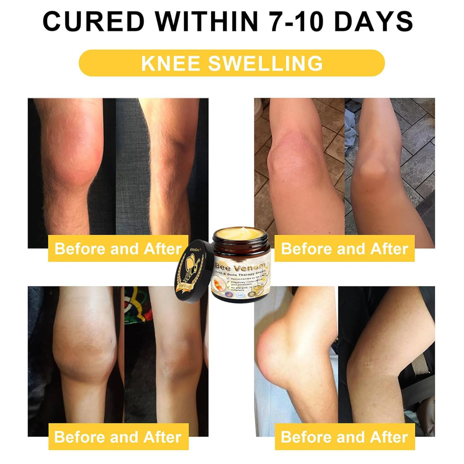 ArthroEase Bee Venom Arthritis Cream, Joint & Muscle Soothing Bee Venom Cream, Professional Bee Venom Joint Cream, Bee Venom Joint Gel - Specially for for Back, Neck, Hands, Knee (2 Bottle) LmoyBuy Supplements Australia