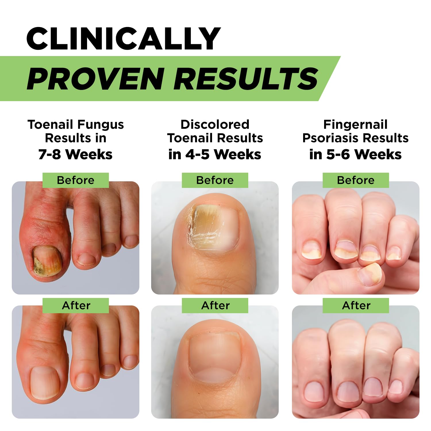 Footcure Antifungal Nail Treatment Pen – Extra Strength Toenail Fungus Treatment - Maple Wellness Supplements