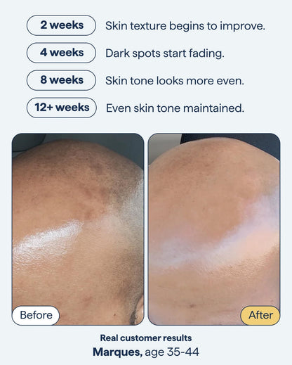 Remedy for Dark Spots | Advanced Night Treatment with Retinol & Kojic Acid | For Discoloration and Uneven Tones | With Glutathione - Maple Wellness Supplements