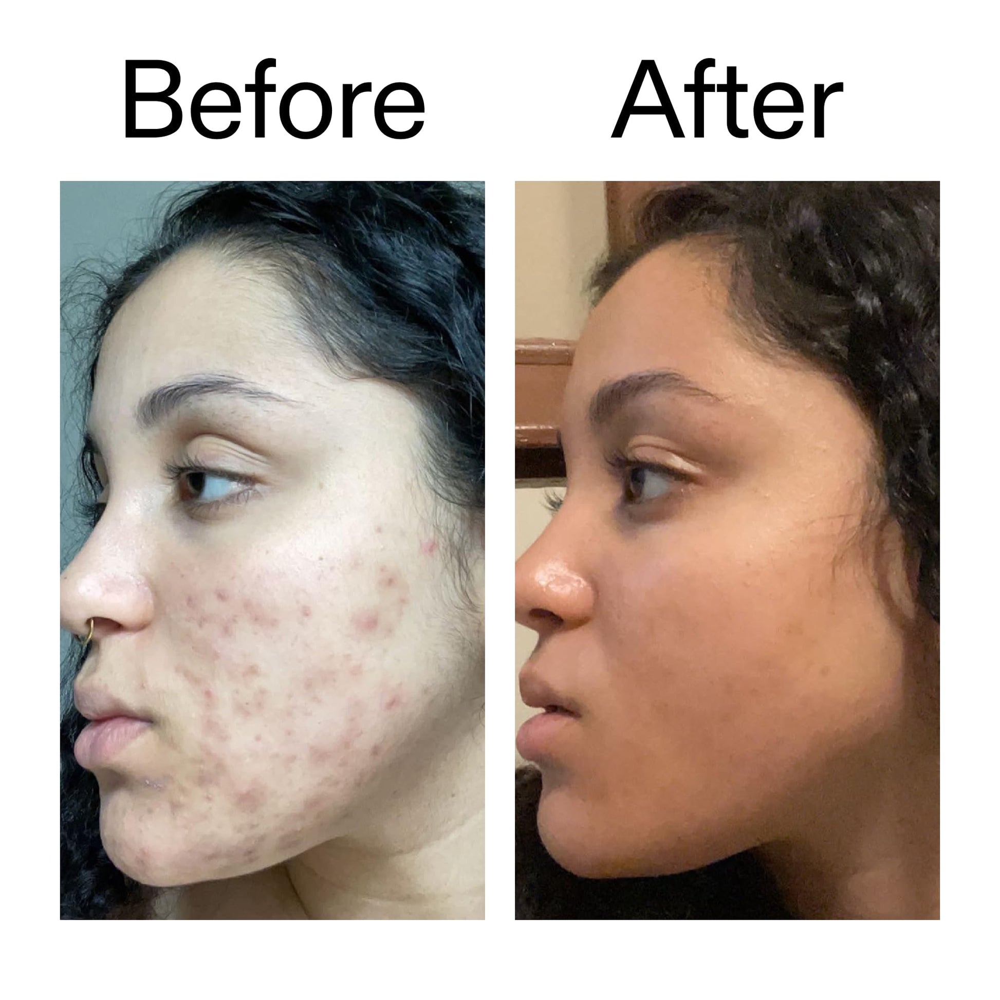 The INKEY List Tranexamic Acid Serum, Helps Reduce Appearance of Skin Discoloration - Maple Wellness Supplements